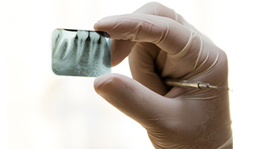 重度の虫歯には根管治療を行います