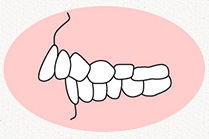 上顎前突(じょうがくぜんとつ)