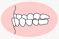 反対咬合(はんたいこうごう)