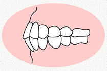 上下顎前突(じょうげがくぜんとつ)