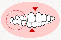 交叉咬合(こうさこうごう)