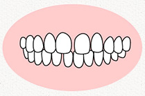 空隙歯列(くうげきしれつ)