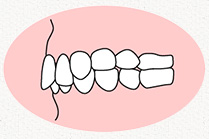過蓋咬合(かがいこうごう)