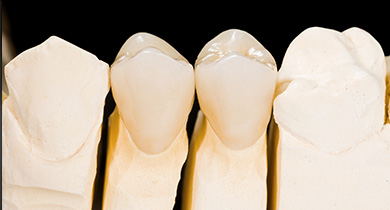 銀歯を白い歯に変えるメリット