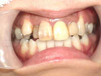 40代女性:前歯をキレイにしたい