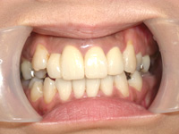 40代女性:前歯をキレイにしたい
