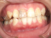 20代女性:前歯の色が気になる