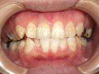20代女性:前歯の色が気になる