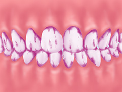 口腔内プラークチェック